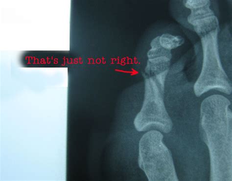 Lowerextremityinjury Amanda Johnson Broken Phalanges Toes