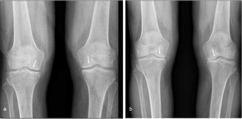 Frontal Radiograph Of Both Knees A Non Weight Bearing Shows Mild