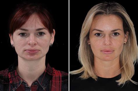 Face Lengthenning And Advancement Aesthetic Jaw Surgery Orthognathic