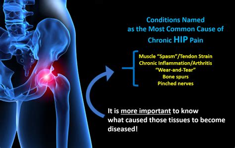 Hip Pain Diagram