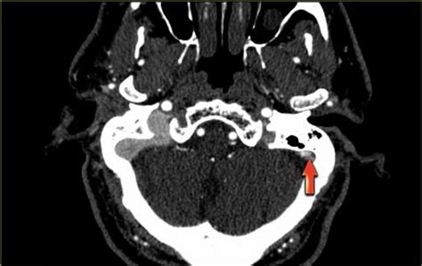 Because of the generally good prognosis and variable clinical signs, many cases remain clinically undetected. The Radiology Assistant : Cerebral Venous Thrombosis