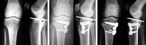 The Effect Of Closed And Open Wedge High Tibial Osteotomy On Tibial
