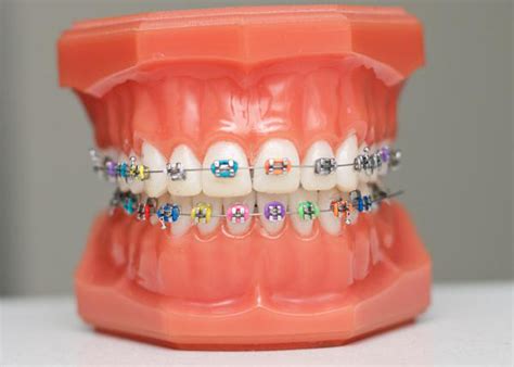 Fixed Braces Brighton And Hove Straighten Your Teeth Splash Orthodontics