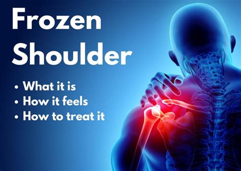 Everything You Need To Know About Frozen Shoulder Adhesive Capsulitis