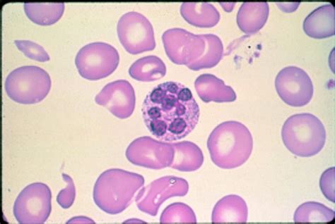 Abc Of Clinical Haematology Macrocytic Anaemias The Bmj