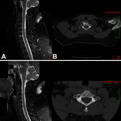 Sagittal T2 Weighted Mri With Fat Suppression Of The Cervical Spine Of