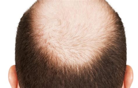 7 Stages Of Male Pattern Baldness Bald Talk