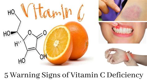 5 Warning Signs Of Vitamin C Deficiency That You Should Not Ignore