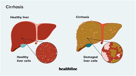 Cirrhosis Incidence Symptoms And Treatment