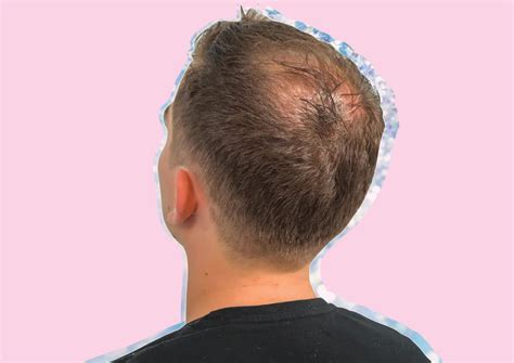 Male Pattern Baldness Causes Prevention The Best Treatments Blog