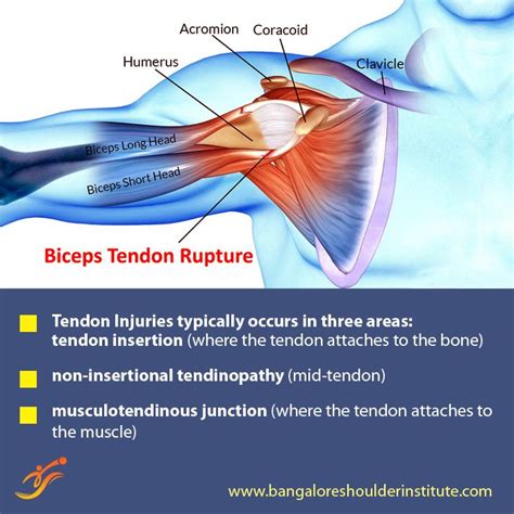 Tendon Injuries Bicep Tendonitis Shoulder Arthroscopy Shoulder Surgery