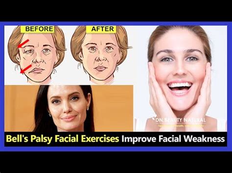 Bell S Palsy Facial Exercises Handout Xpcourse