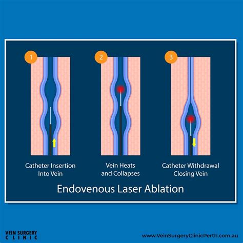 Endovenous Laser Ablation Evla Vein Surgery Clinic Of Perth