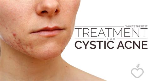 Whats The Best Treatment For Cystic Acne