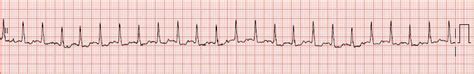 Float Nurse EKG Rhythm Strips Atrial Rhythms