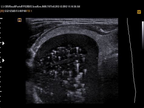 VIETNAMESE MEDIC ULTRASOUND CASE 157 THYROID CYST With COMET TAIL