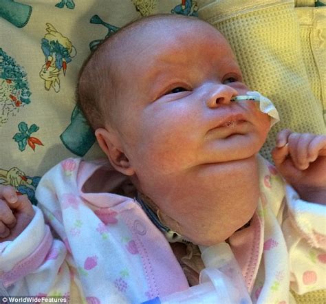 Girl Who Was Born With A Neck Tumour The Size Of A Tennis Ball Survives