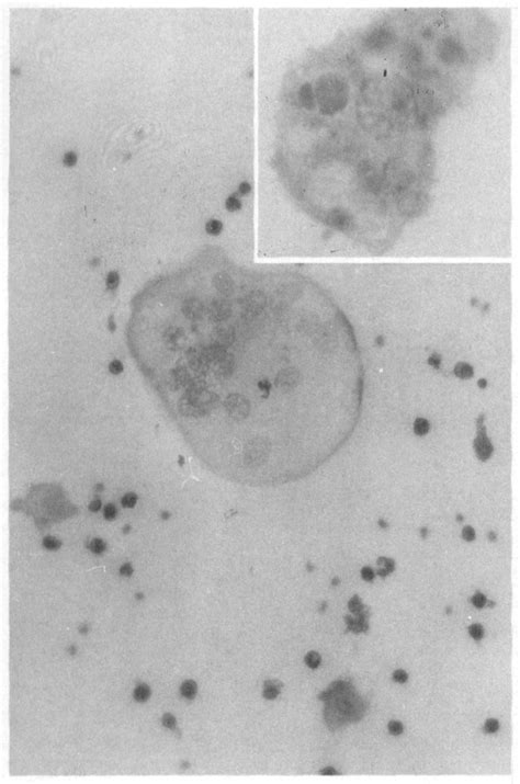 Photomicrograph Of Urine Deposit Smear From A Patient With Urinary