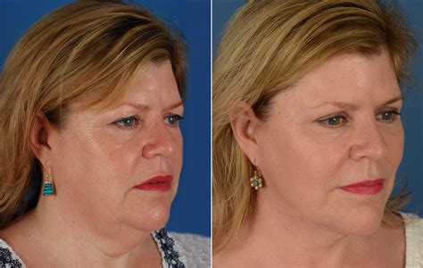 The Uplift Lower Face And Neck Lift Photos Naples Fl Patient 11683