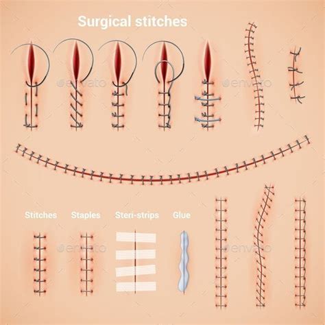 Surgical Stitches Infographic Set Medical School Essentials Medicine