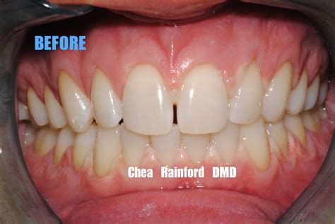 9 Before Veneer Vibrant Smiles Mableton Ga Dentist Dr Chea Rainford