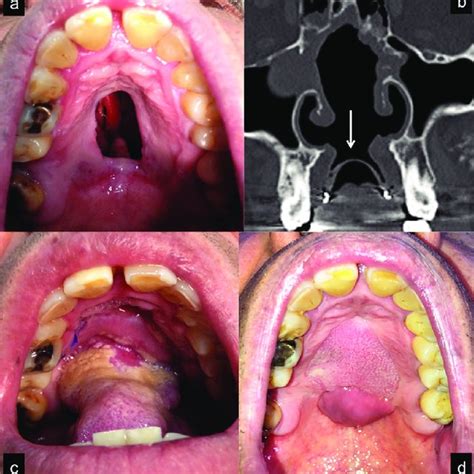 Patient With A 1 Cm Perforation In The Junction Between Soft And Hard