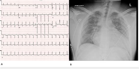 A Initial EKG Demonstrating Sinus Tachycardia B Chest Radiograph