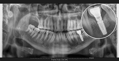 Tooth And Dental Implant Xray Stock Photo Download Image Now Istock