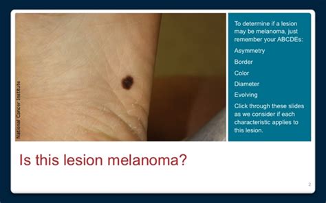 Learn The Signs Of Melanoma Oncology Nurse Advisor