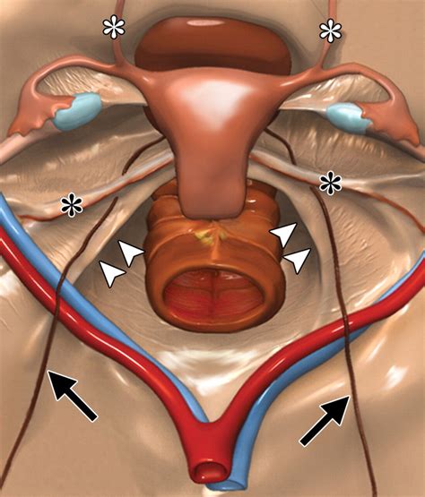 Mr Imaging In Deep Pelvic Endometriosis A Pictorial Essay Radiographics