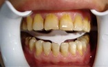 牙齒變黃不可怕，用對方法是關鍵，牙醫這招一次就可根除大黃牙 - 每日頭條