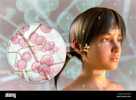 Chronic Fungal Otitis Media Ear Infection Computer Illustration