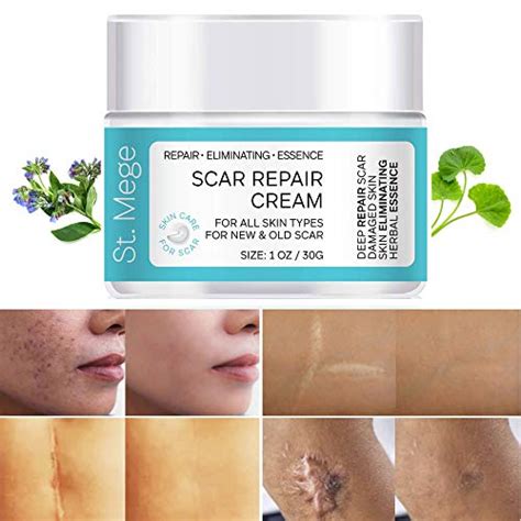 15 Best Scar Removal Creams Of 2023 Reviews And Buying Guide