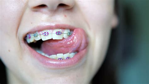 Beautiful Girl With Braces On His Teeth White Posing For The Camera Black Stock Footage Video