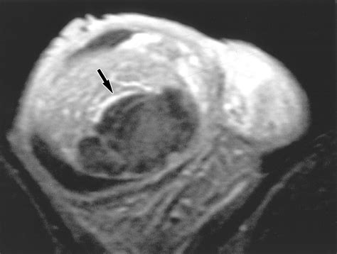 Sonographic And Mr Imaging Findings Of Testicular Epidermoid Cysts Ajr