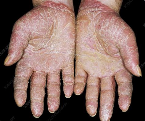 Psoriasis On The Palms Of The Hands Stock Image C0142544 Science