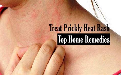 8 Helpful Home Remedies To Treat Prickly Heat Rash