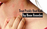 How To Treat Prickly Heat Rash On Neck | Allergy Trigger