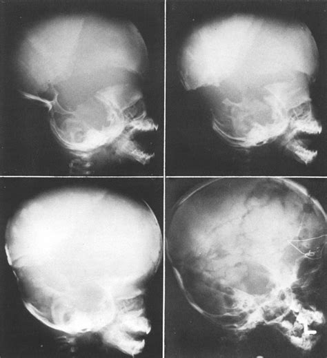 Cloverleaf Skull Syndrome In Journal Of Neurosurgery Volume 43 Issue 1