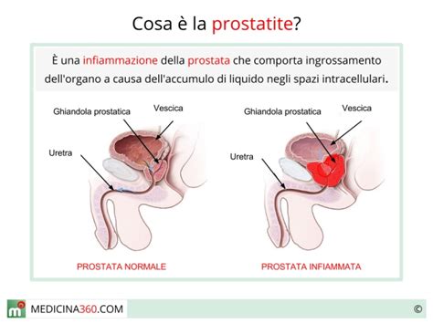 Prostatite Sintomi Cause Cure E Rischi Della Prostata Infiammata