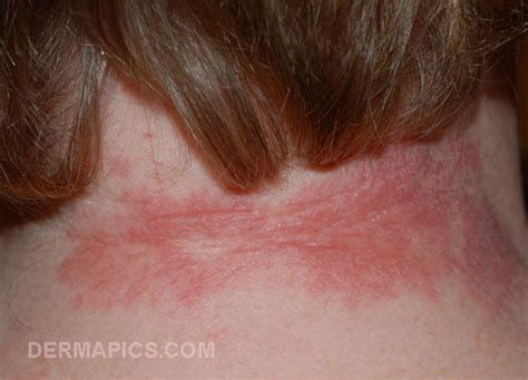 Red Spots And Rash The Most Common Types Compared