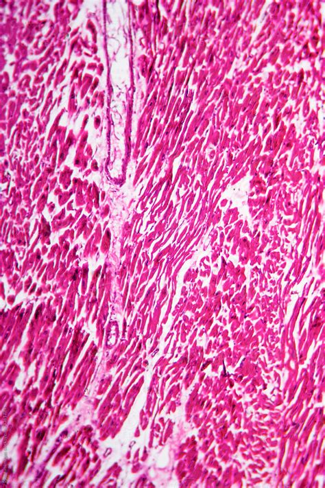 Rheumatic Endocarditis Human Cells Micrograph Stock Image Everypixel