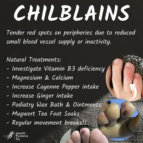 Chilblains Winter Toes