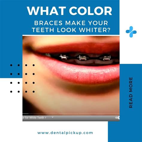 What Color Braces Make Your Teeth Look Whiter Dental Pickup