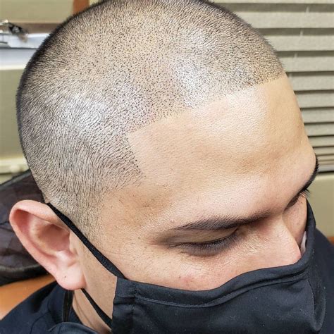Smp Mobilesome Important Differences Between Scalp Micropigmentation