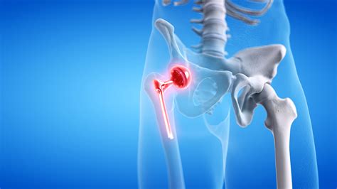 Hip Replacement Surgeon Greenville Nc