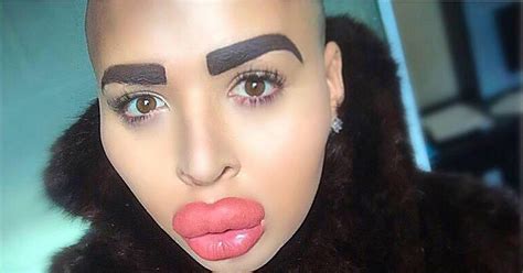 Man Who Inflated Lips To Look Like Kim Kardashian Has Pout Reduced
