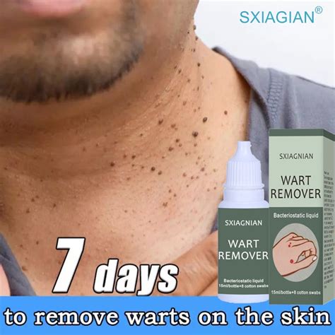 100 Effective Warts Remover Original Warts Magic Remover Wart Removal