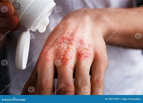 Eczema On The Hands The Man Applying The Ointment Creams In The