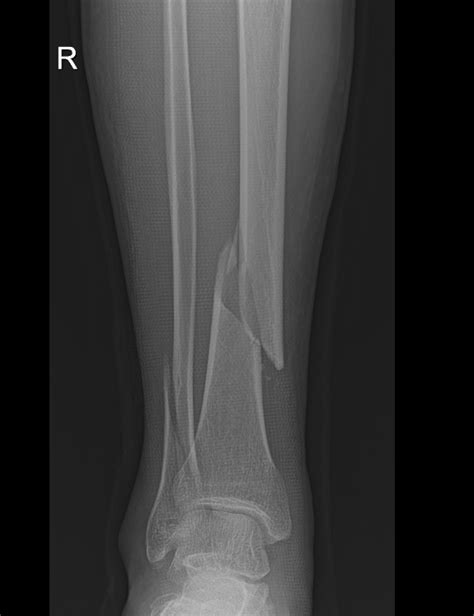 Tibia Shaft Fractures Trauma